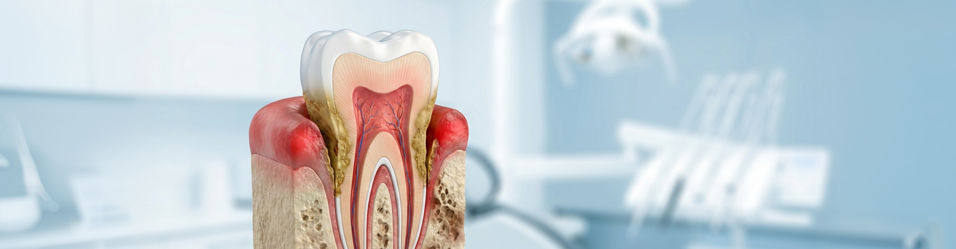 Cross-sectional illustration of a tooth showing inflamed, swollen gums and plaque buildup along the roots, depicting gum disease.